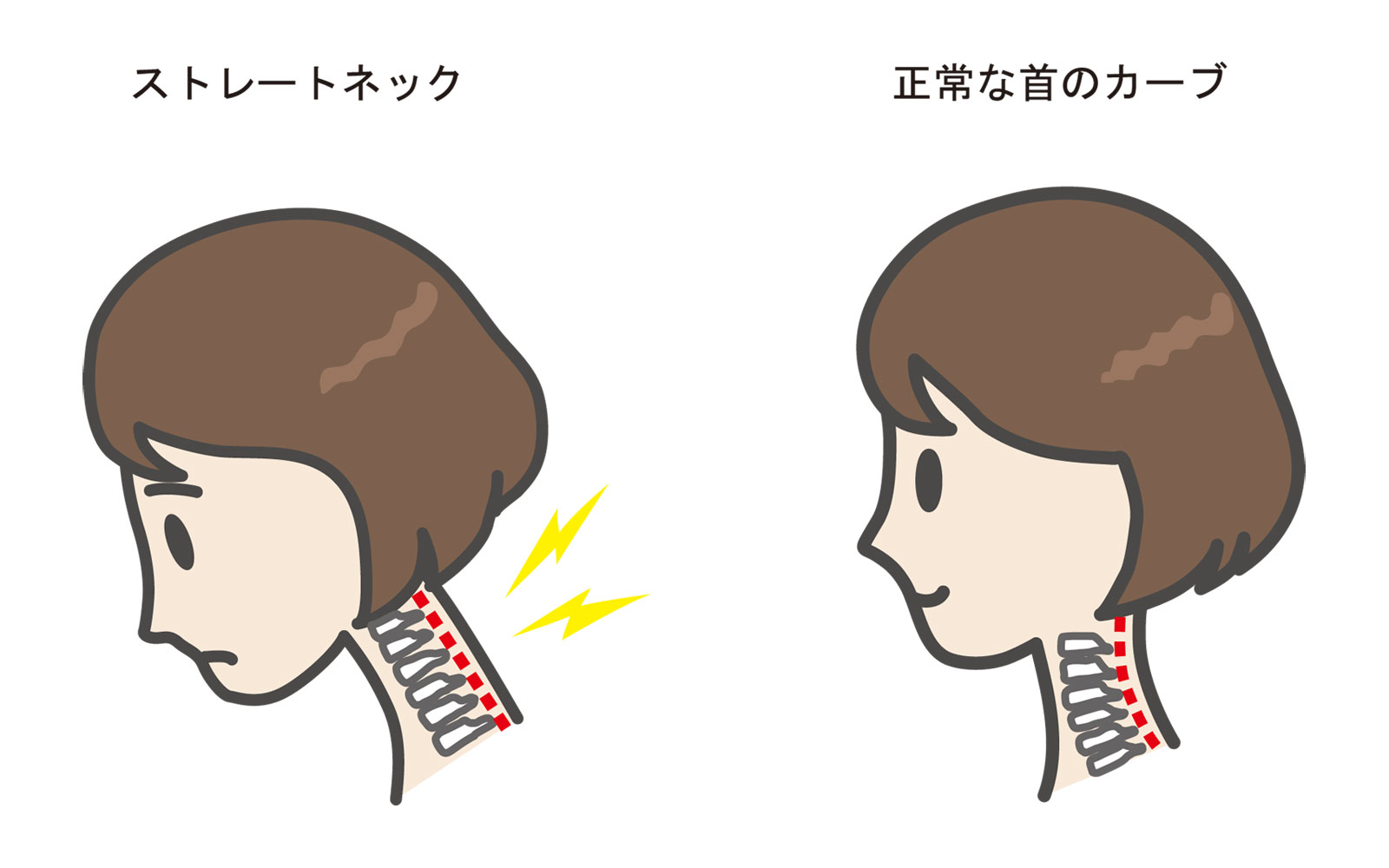ストレートネックとは